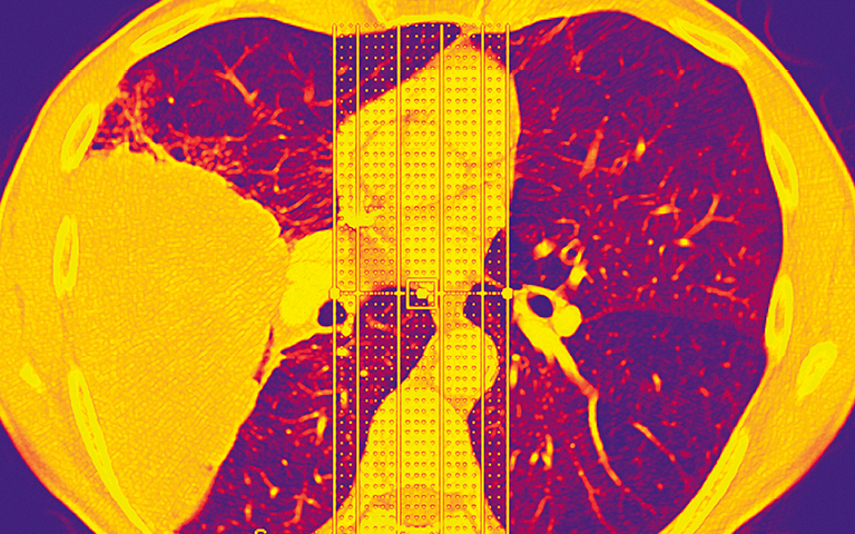 Photo – Lung CT scan