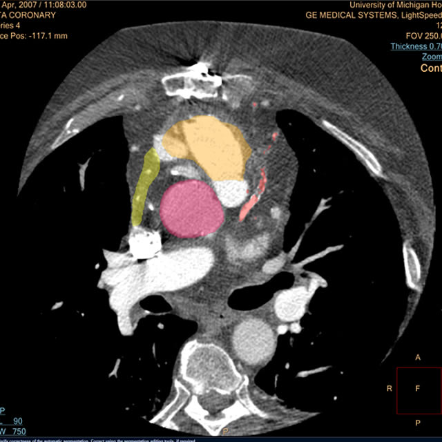 CoronaryCTA_640
