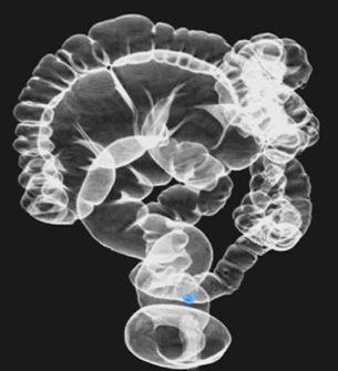 Computed tomographic colonography is an alternative to traditional colonography